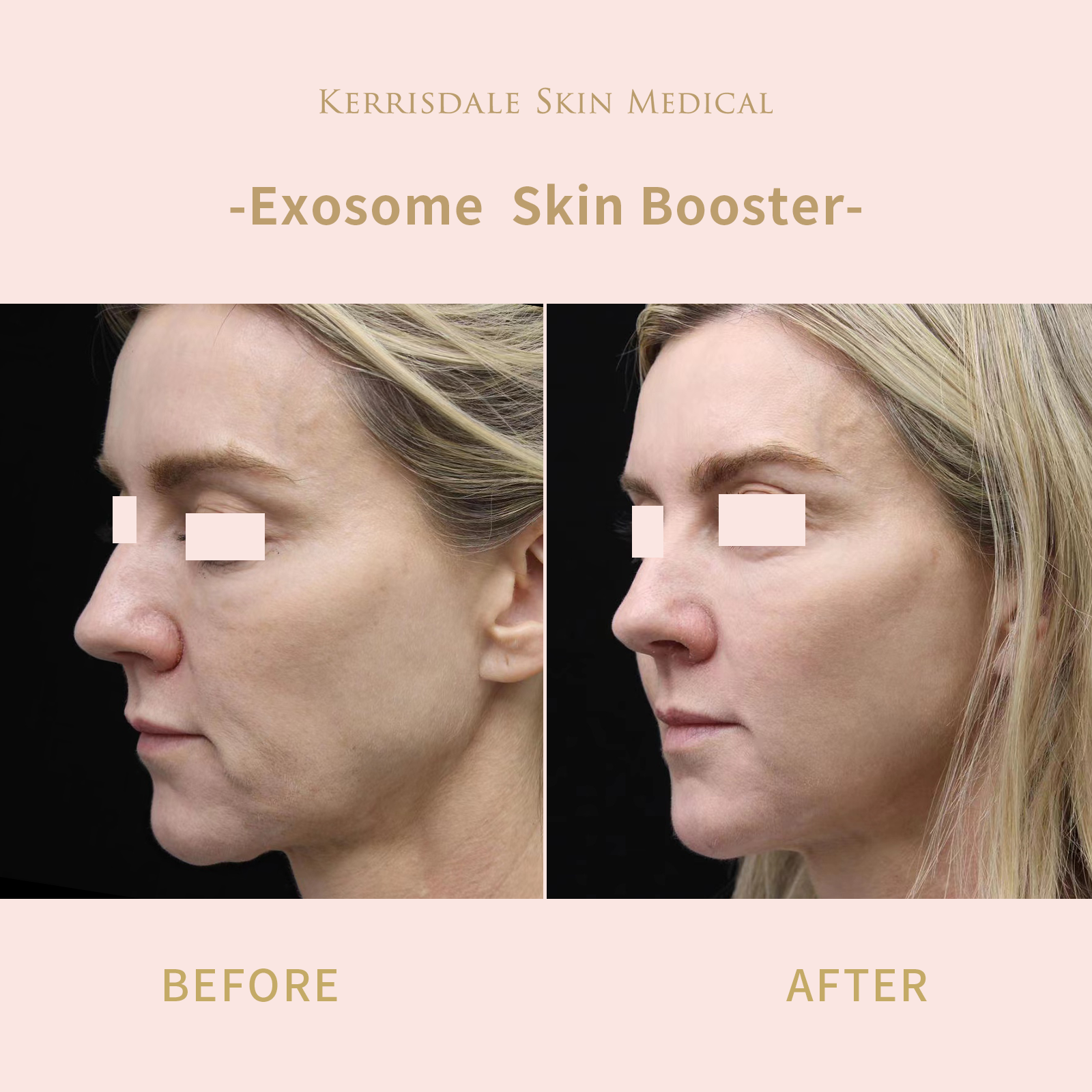 Exosome Skin Booster (New Customers Only)