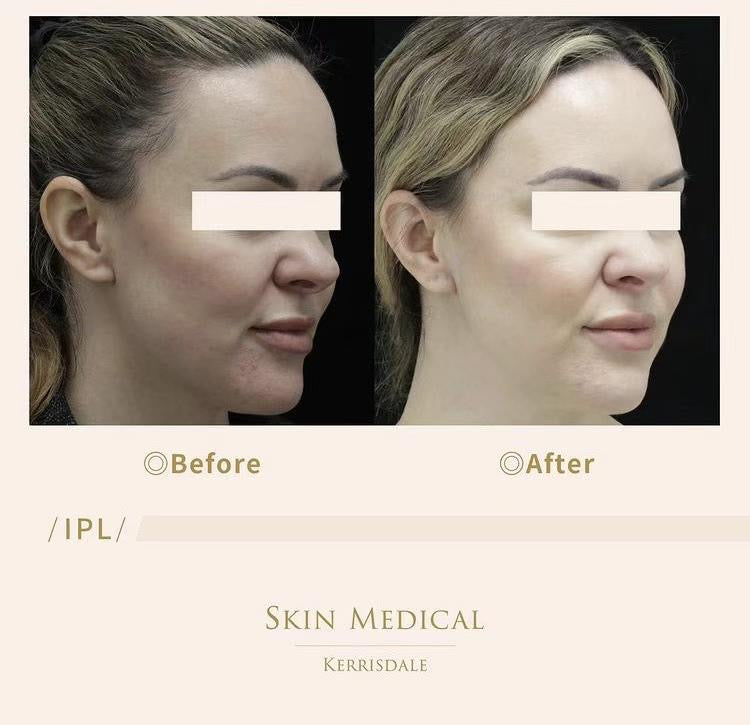 IPL (Intense Pulsed Light) Skin Rejuvenation