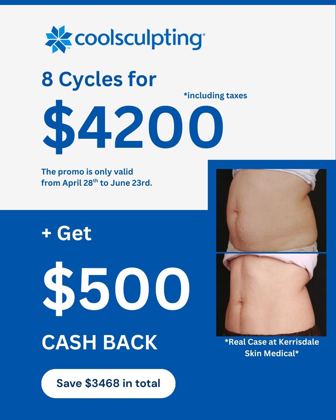 CoolSculpting®