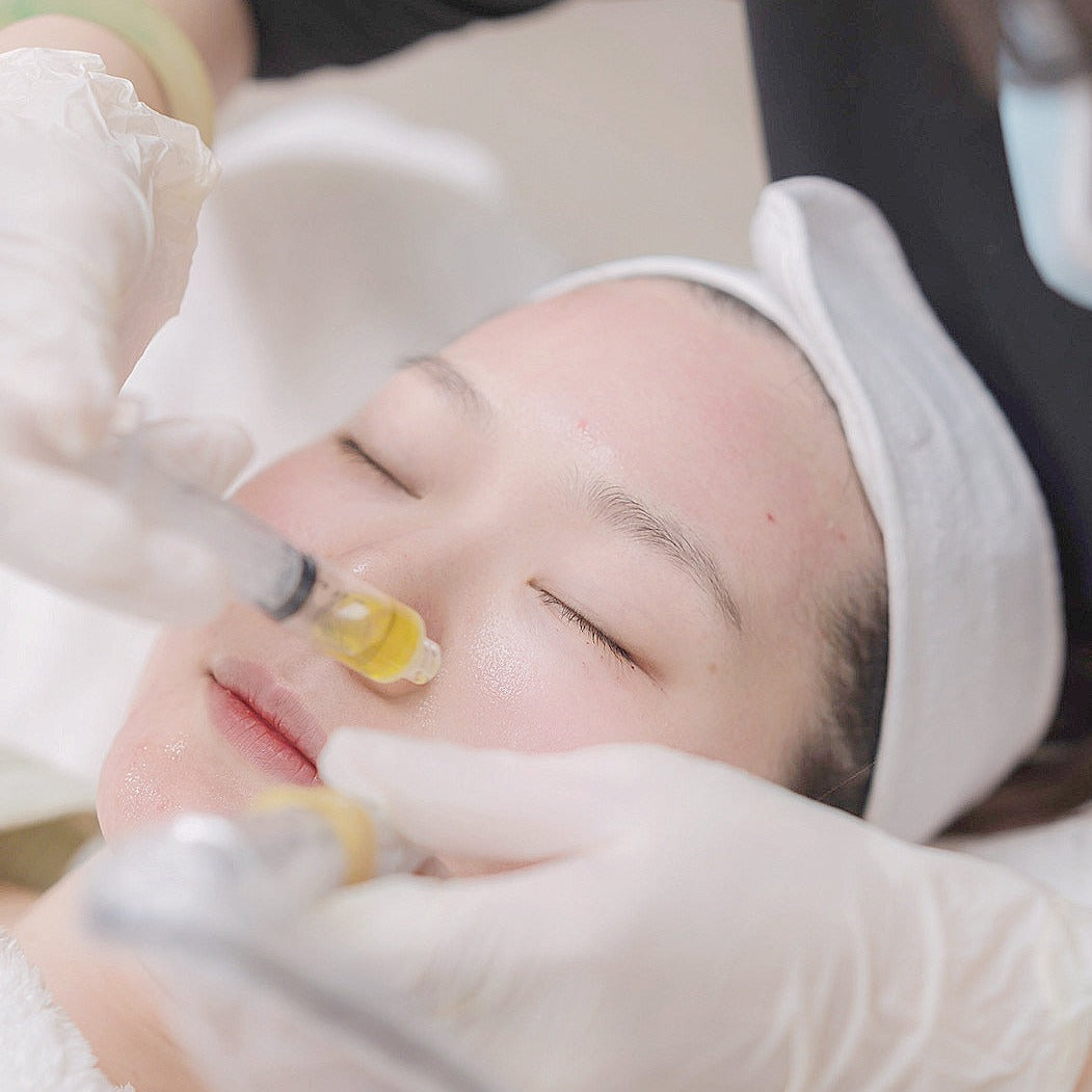 PRP Vampire Treatment