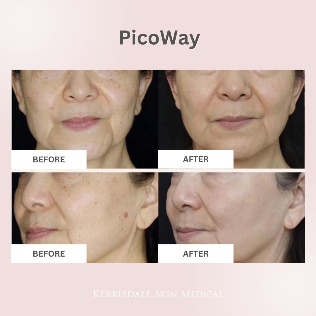 March Promo | PicoWay® Laser Treatment