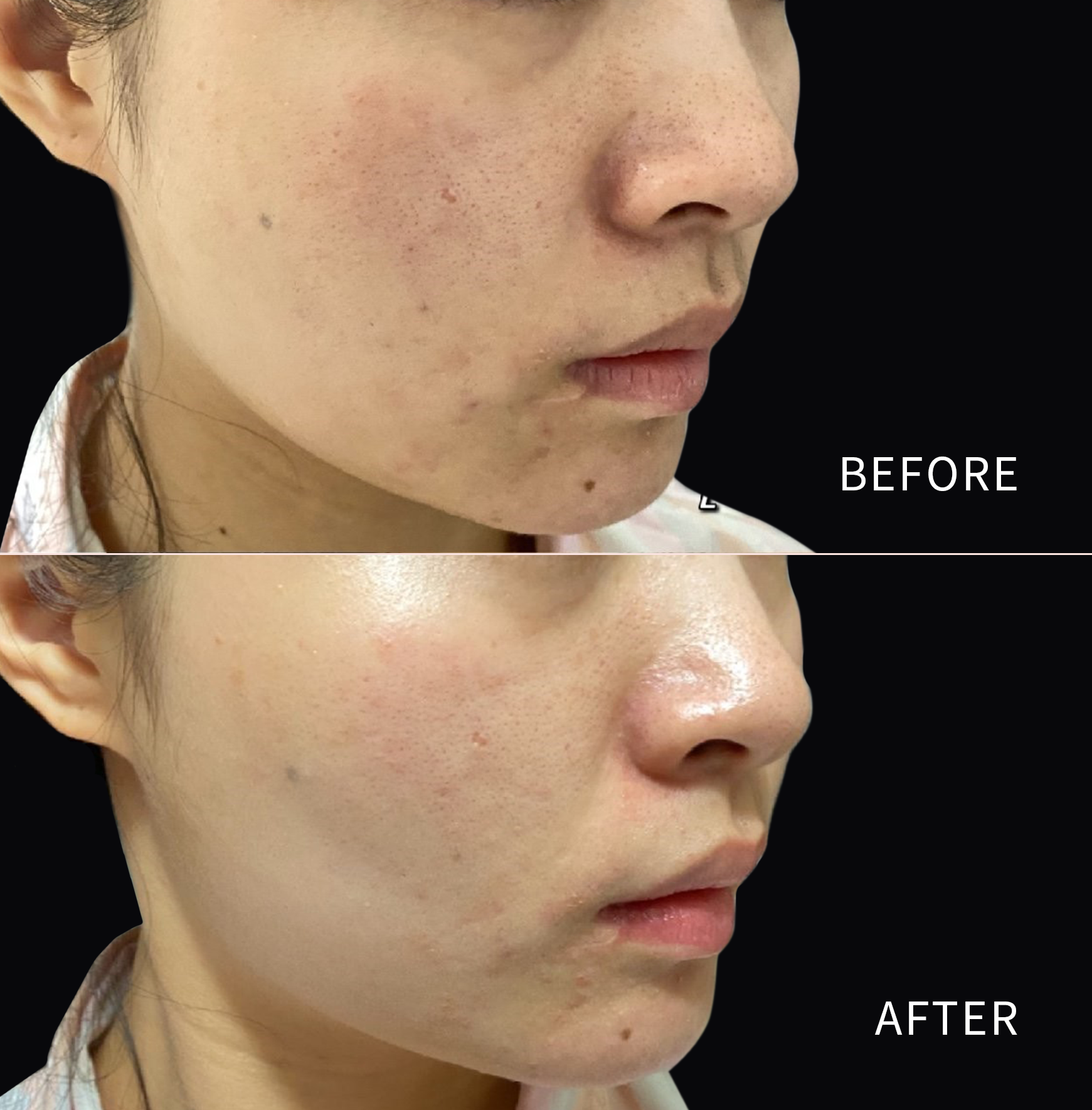 ๐ข๐ฝ๐ฒ๐ป ๐๐ผ๐๐๐ฒ ๐ฃ๐ฟ๐ผ๐บ๐ผ | Lutronicยฎ Infiniโข RF Microneedling
