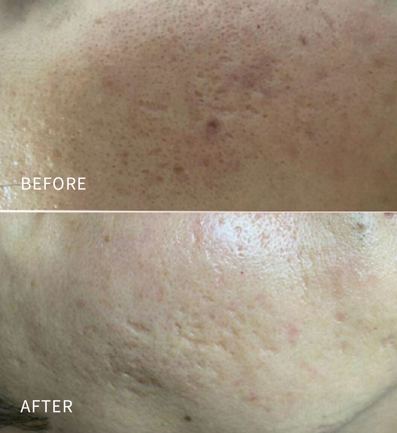 ๐ข๐ฝ๐ฒ๐ป ๐๐ผ๐๐๐ฒ ๐ฃ๐ฟ๐ผ๐บ๐ผ | Lutronicยฎ Infiniโข RF Microneedling