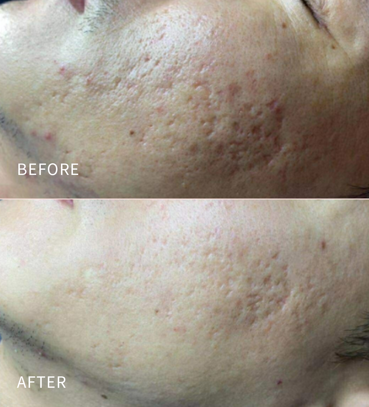 ๐ข๐ฝ๐ฒ๐ป ๐๐ผ๐๐๐ฒ ๐ฃ๐ฟ๐ผ๐บ๐ผ | Lutronicยฎ Infiniโข RF Microneedling