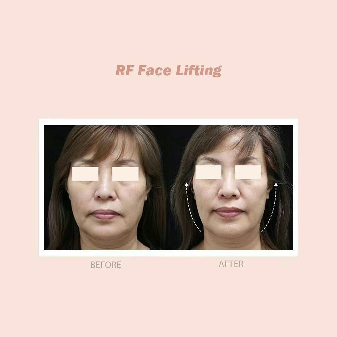 RF Facelifting