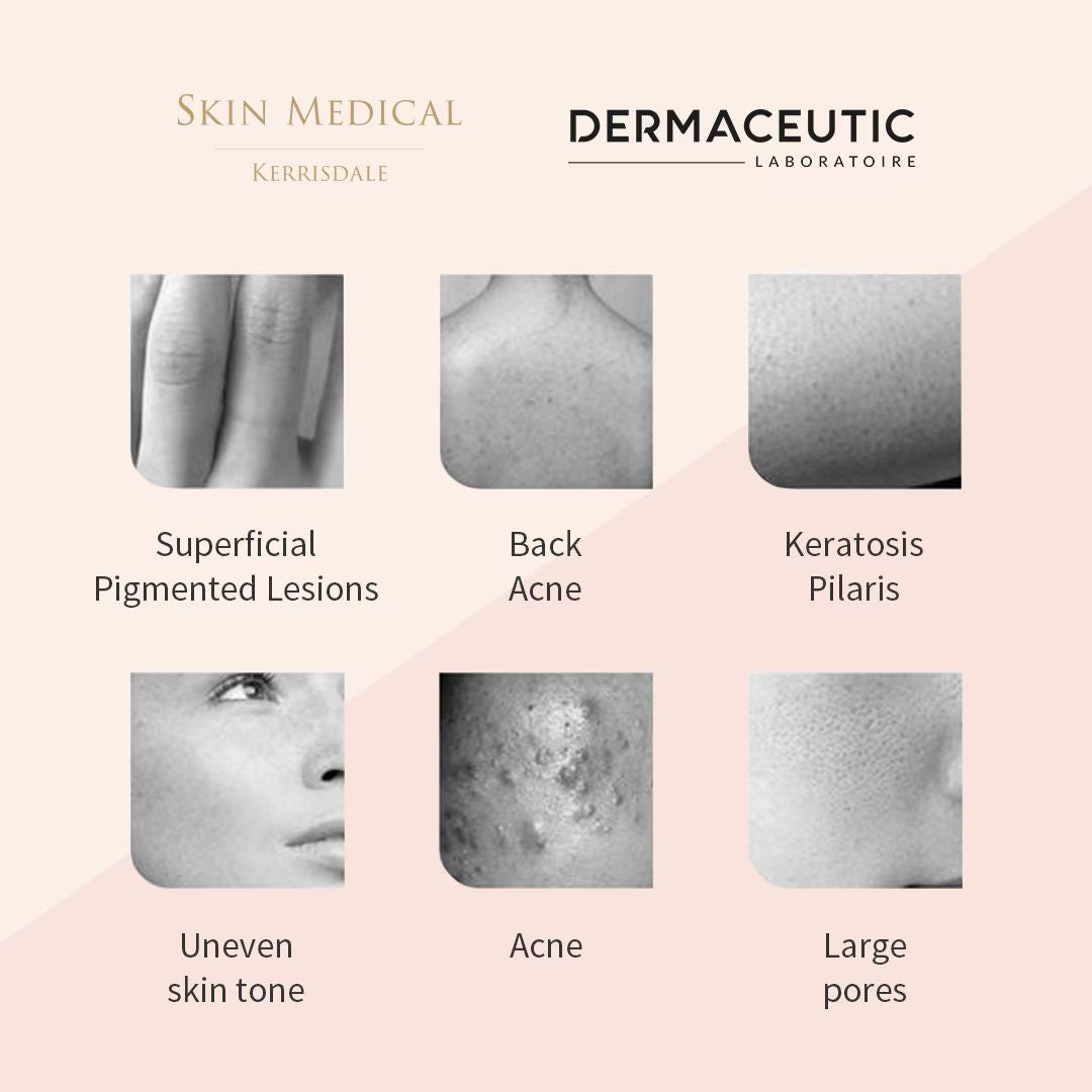 Milk Peel Treatment (In-Office Procedure)