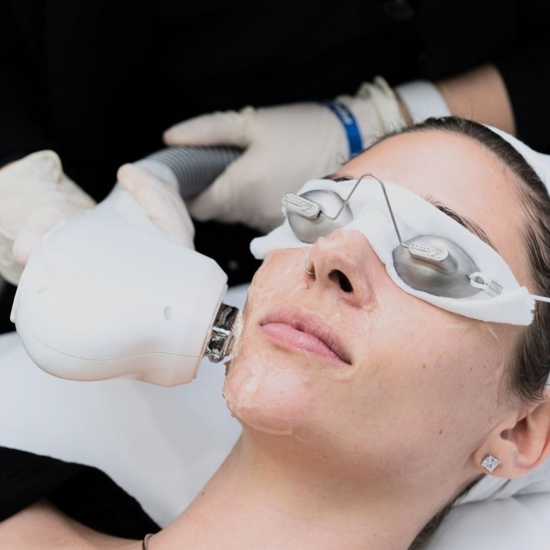 IPL (Intense Pulsed Light) Skin Rejuvenation (New Customers Only)