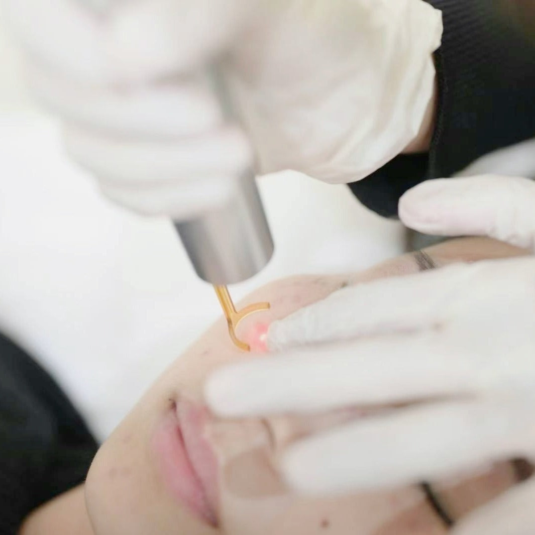 March Promo | PicoWay® Laser Treatment