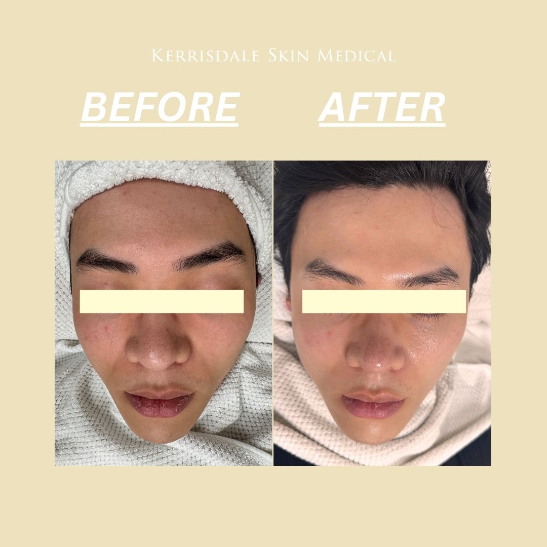 IdolSkin Glossa Treatment
