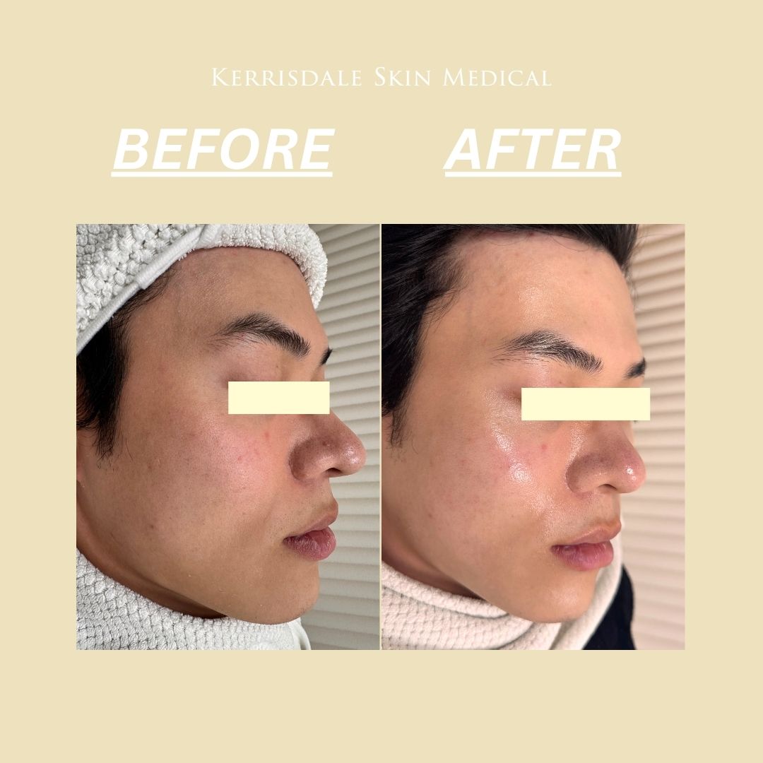 IdolSkin Glossa Treatment