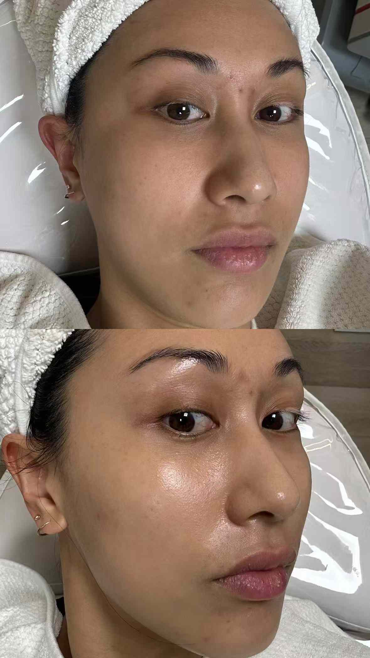 IdolSkin Glossa Treatment