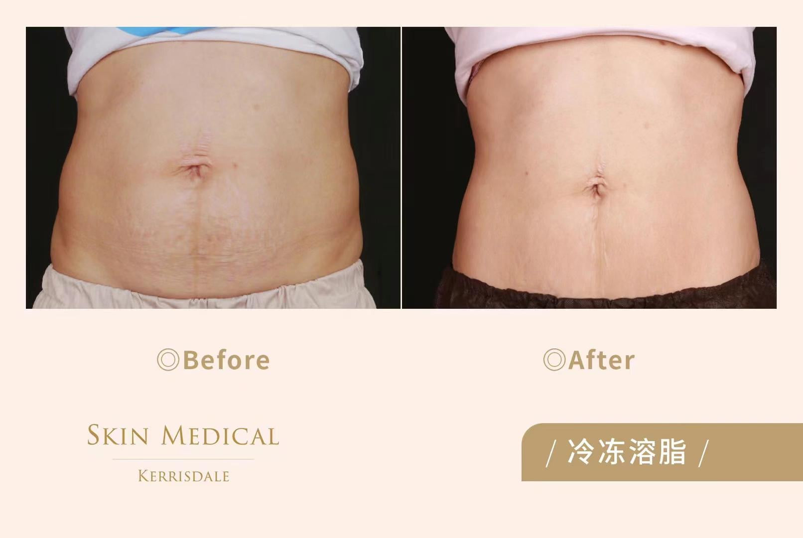 CoolSculpting®