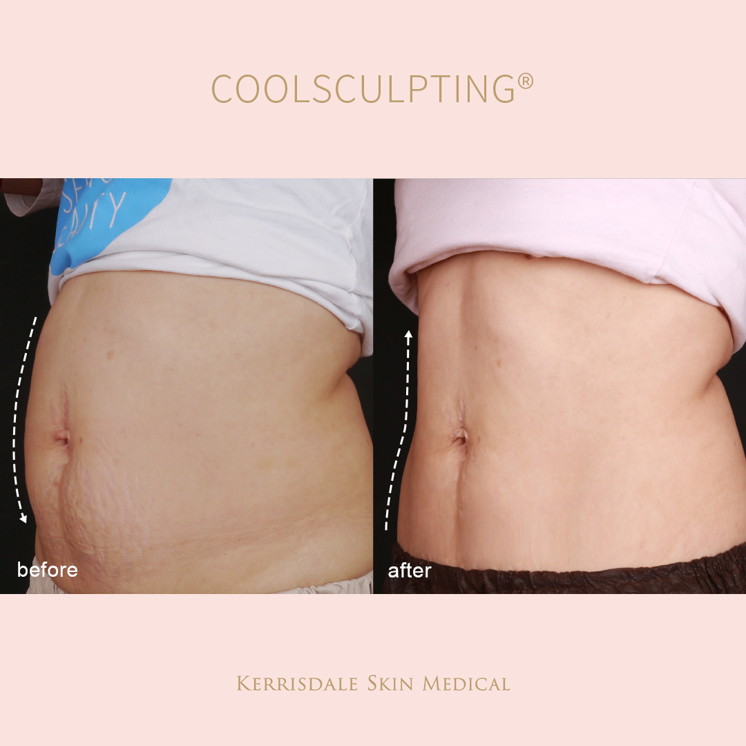 CoolSculpting®