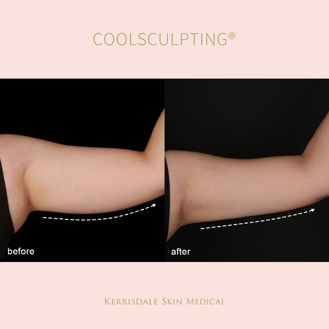 $10 for CoolSculpting® $300 coupon - Online Only