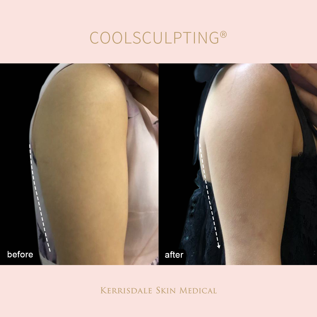 $10 for CoolSculpting® $300 coupon - Online Only