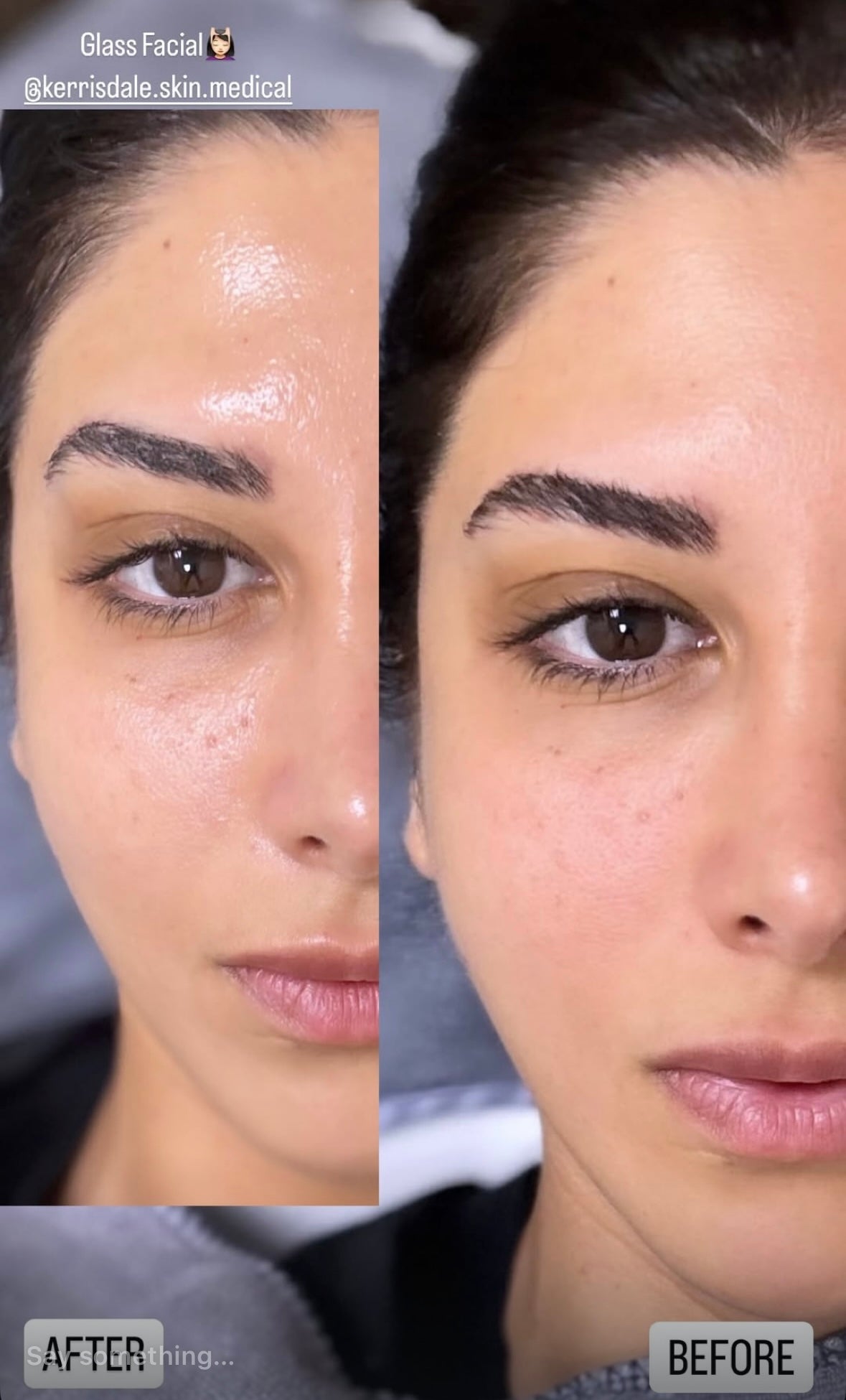 IdolSkin Glossa Treatment
