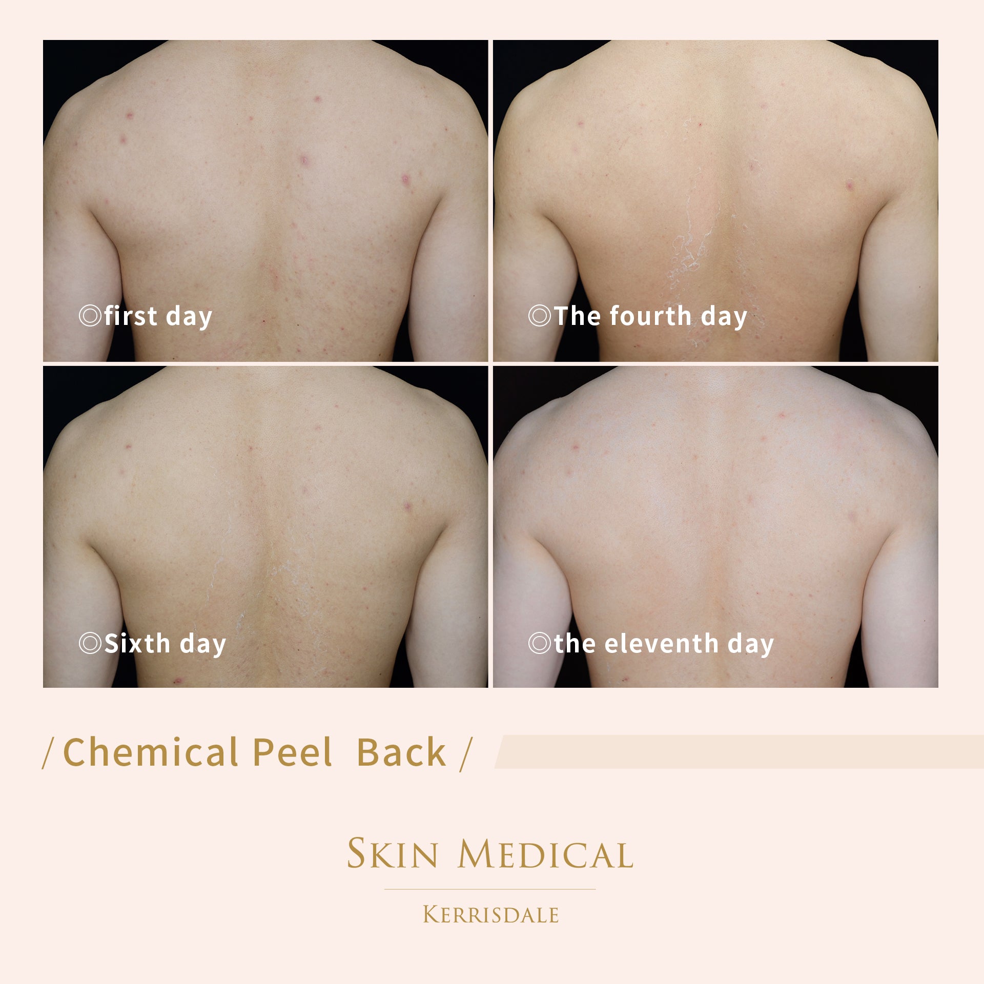 Chemical Peel