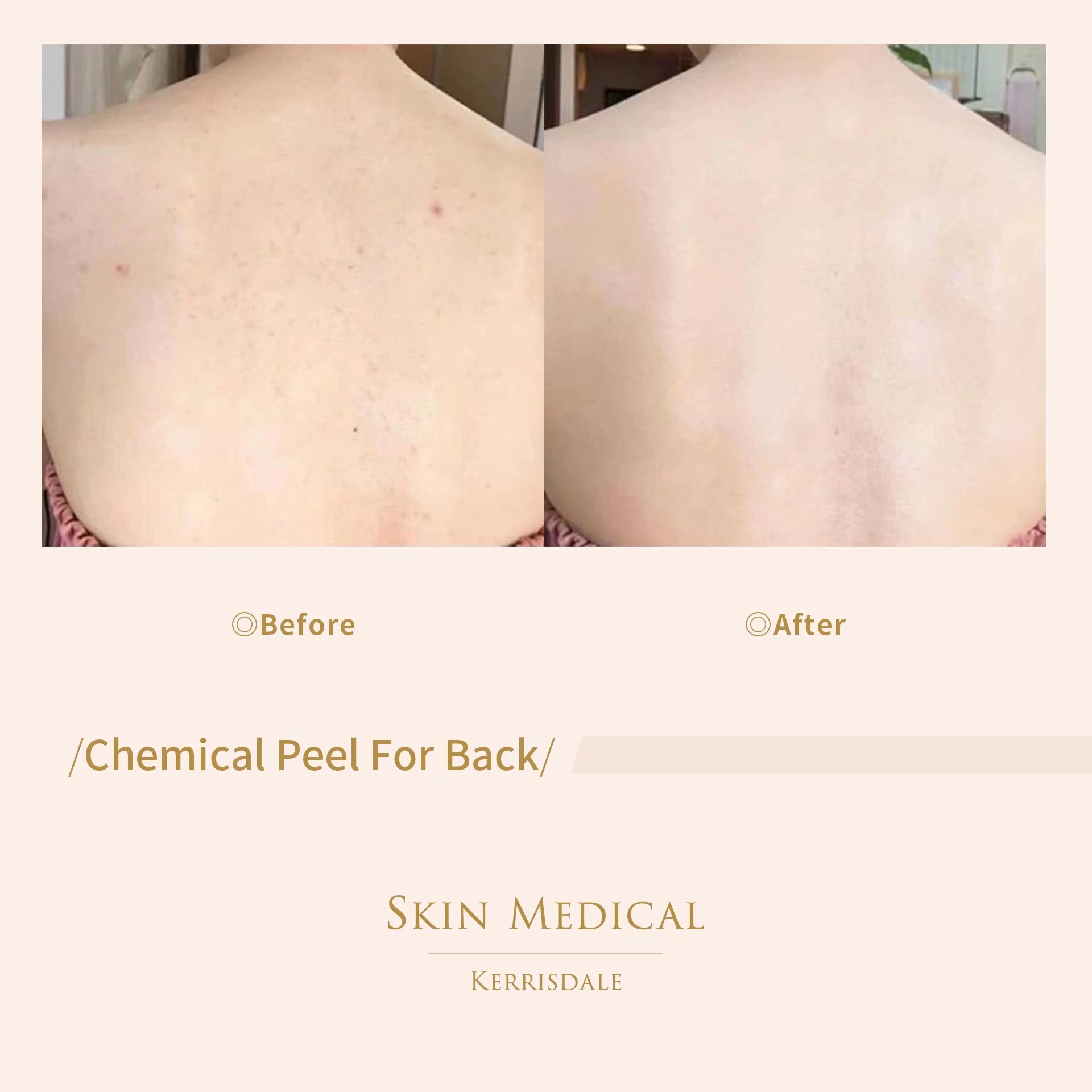 Chemical Peel