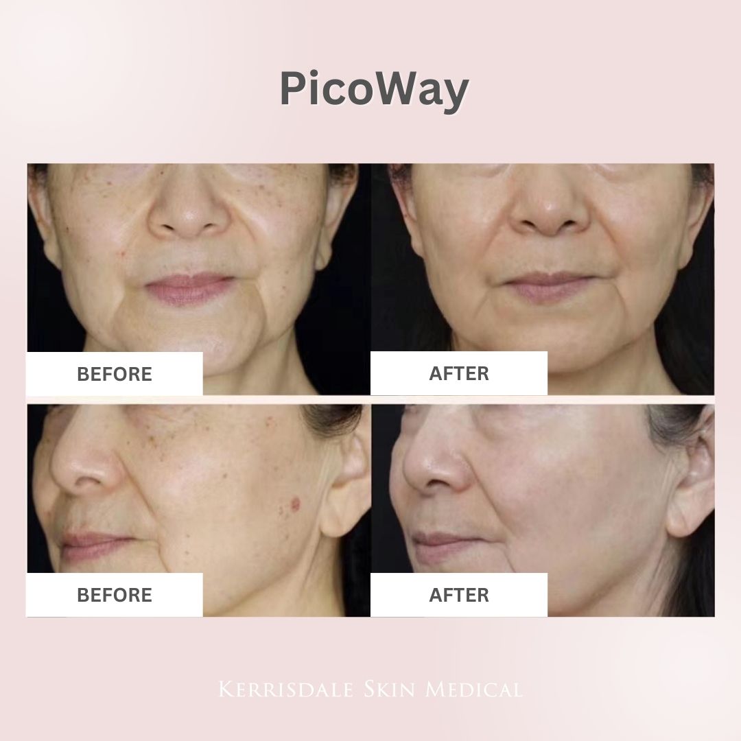 PicoWay® Laser Treatment