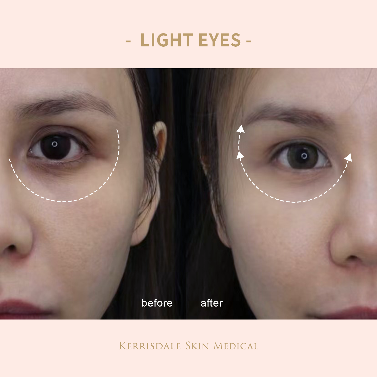 Light Eye Treatment +PDRN