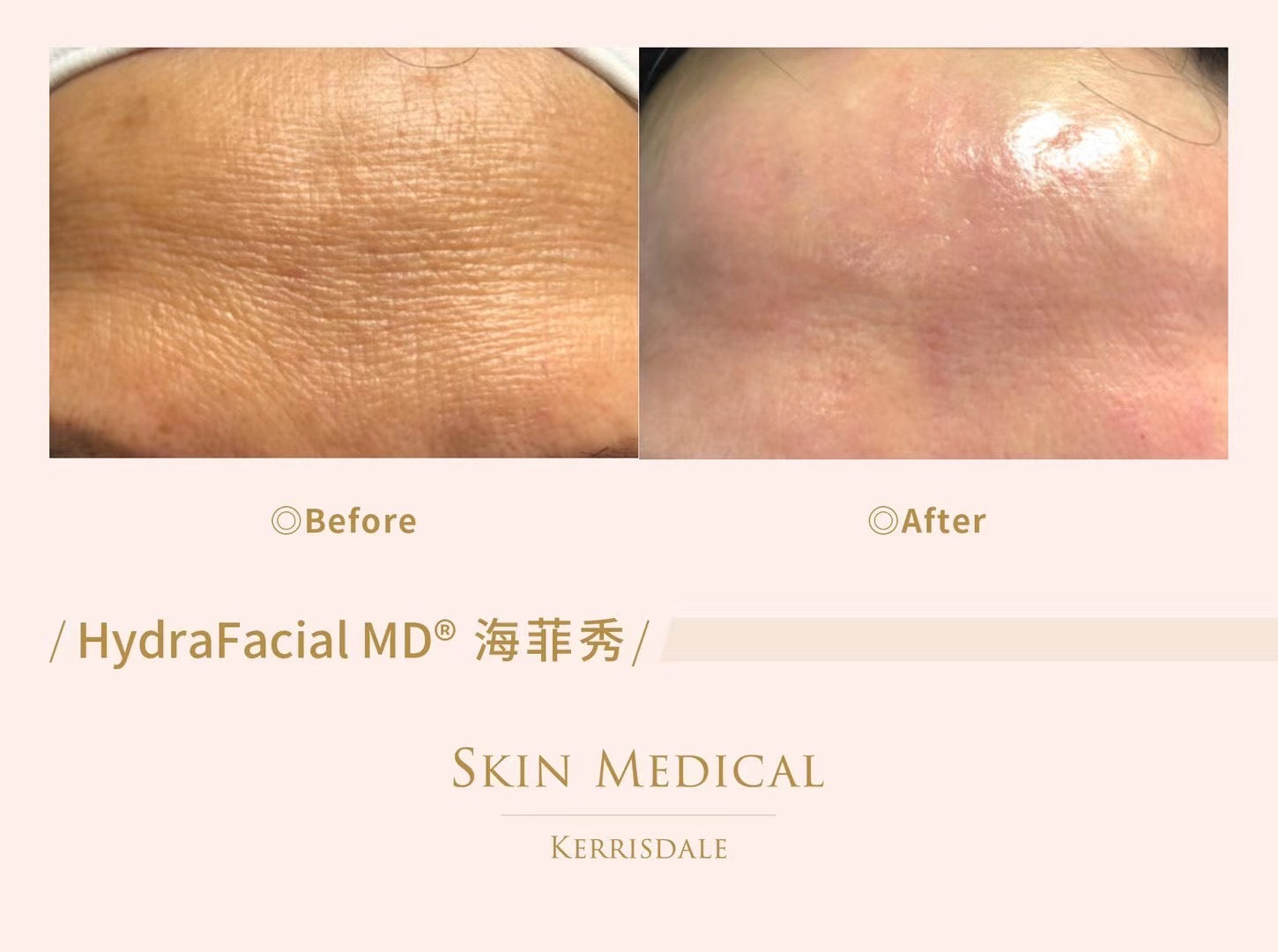 HydraFacial MD ®