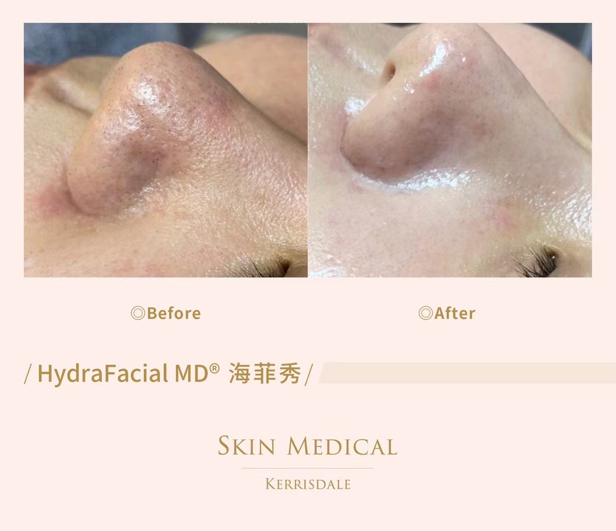 HydraFacial MD ®